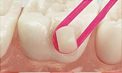 Bite Ramp Application