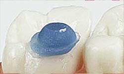 Bite Ramp Application