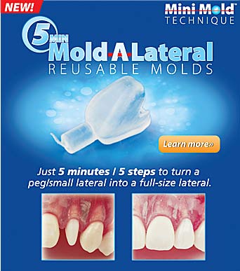 New Lateral Bonding Kit