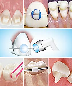 Bite Ramp Application