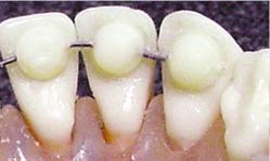 Bite Ramp Application